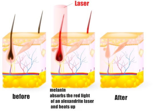 How Does Laser Hair Removal Work? - Laser Hair Removal - Melisa Laser Clinic